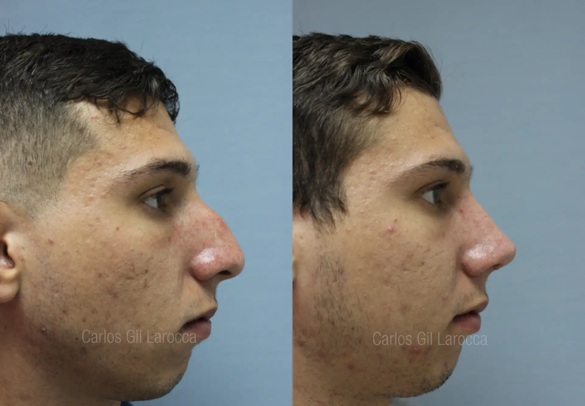 Resultado de rinoplastia, caso 18