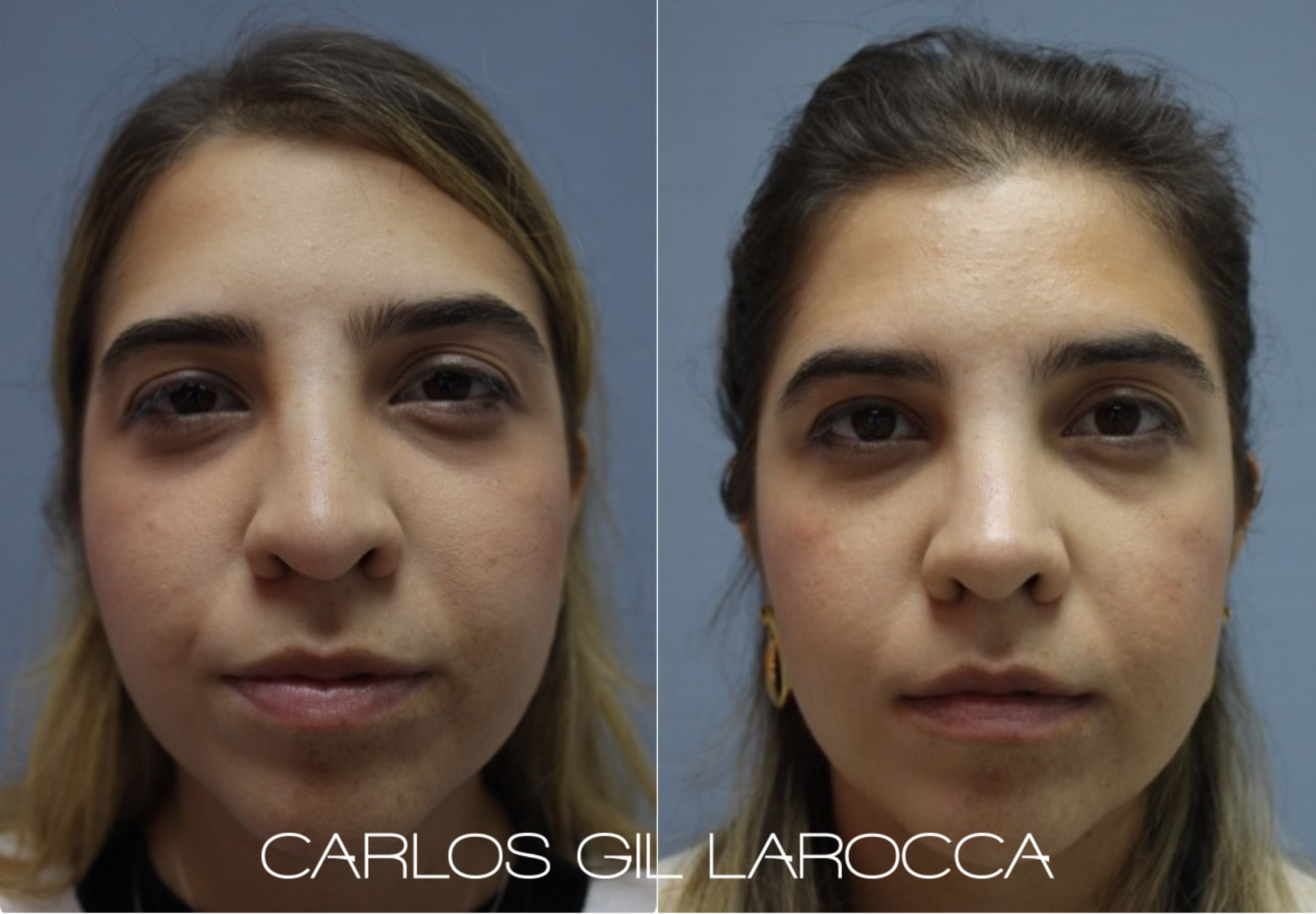 Resultado de rinoplastia, caso 7, vista 1
