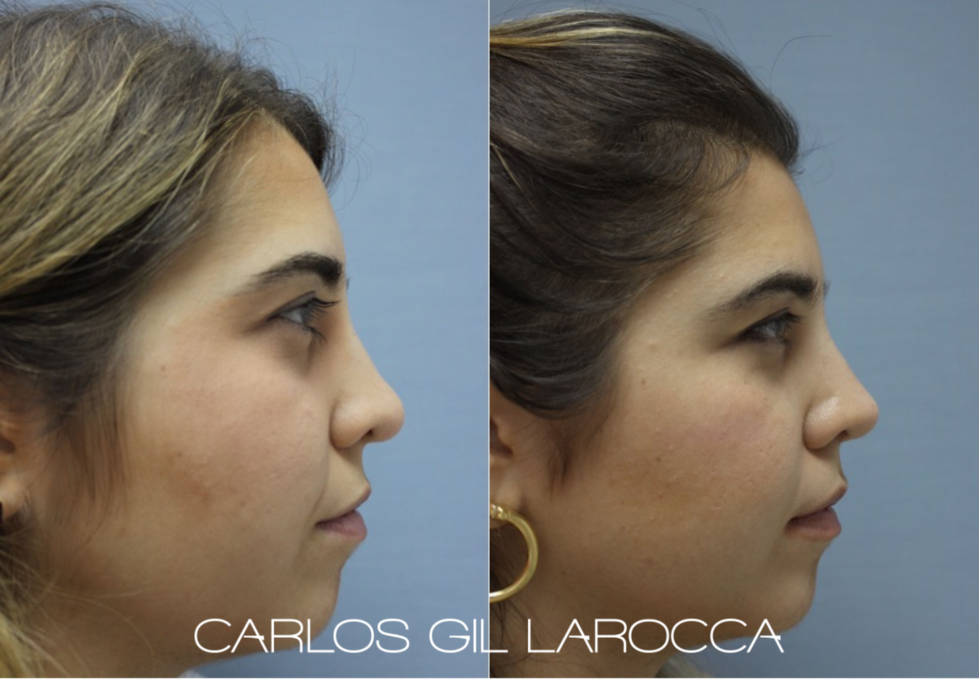 Resultado de rinoplastia, caso 7, vista 2