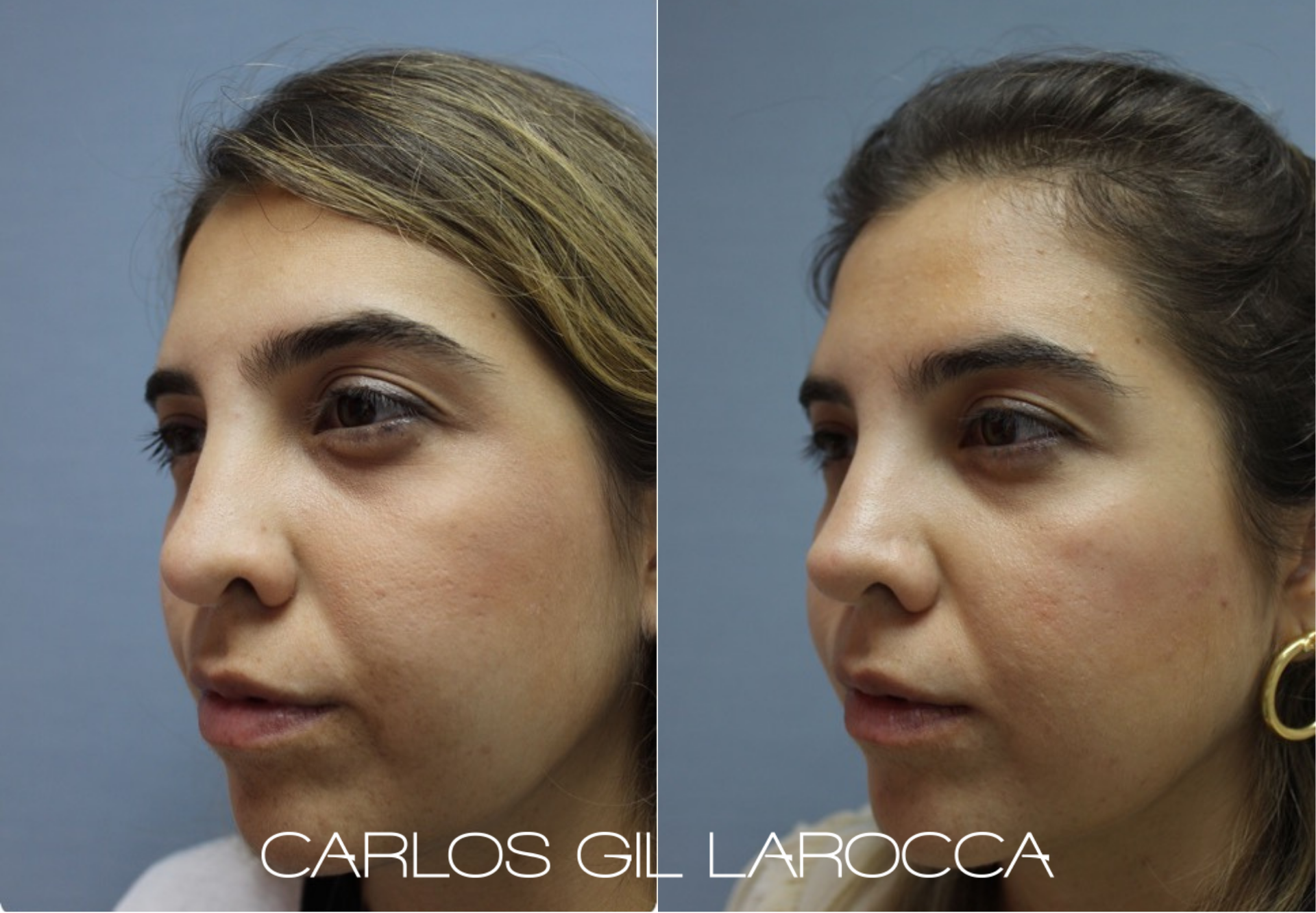 Resultado de rinoplastia, caso 7, vista 3