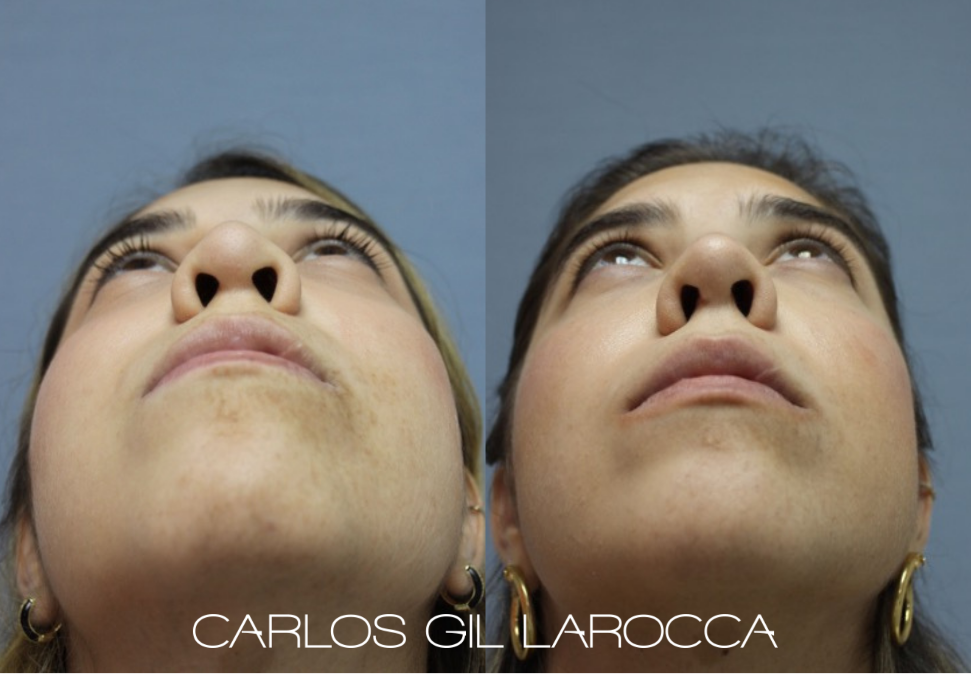 Resultado de rinoplastia, caso 7, vista 4