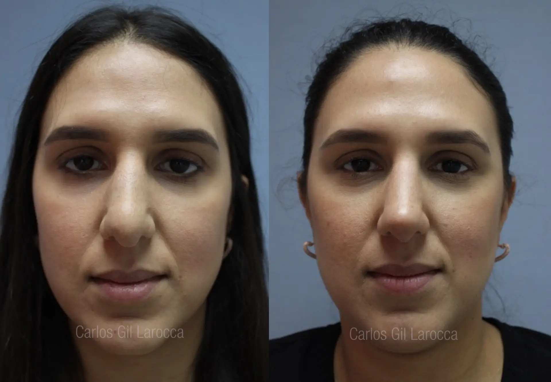 Resultado de rinoplastia, caso 2, vista 1