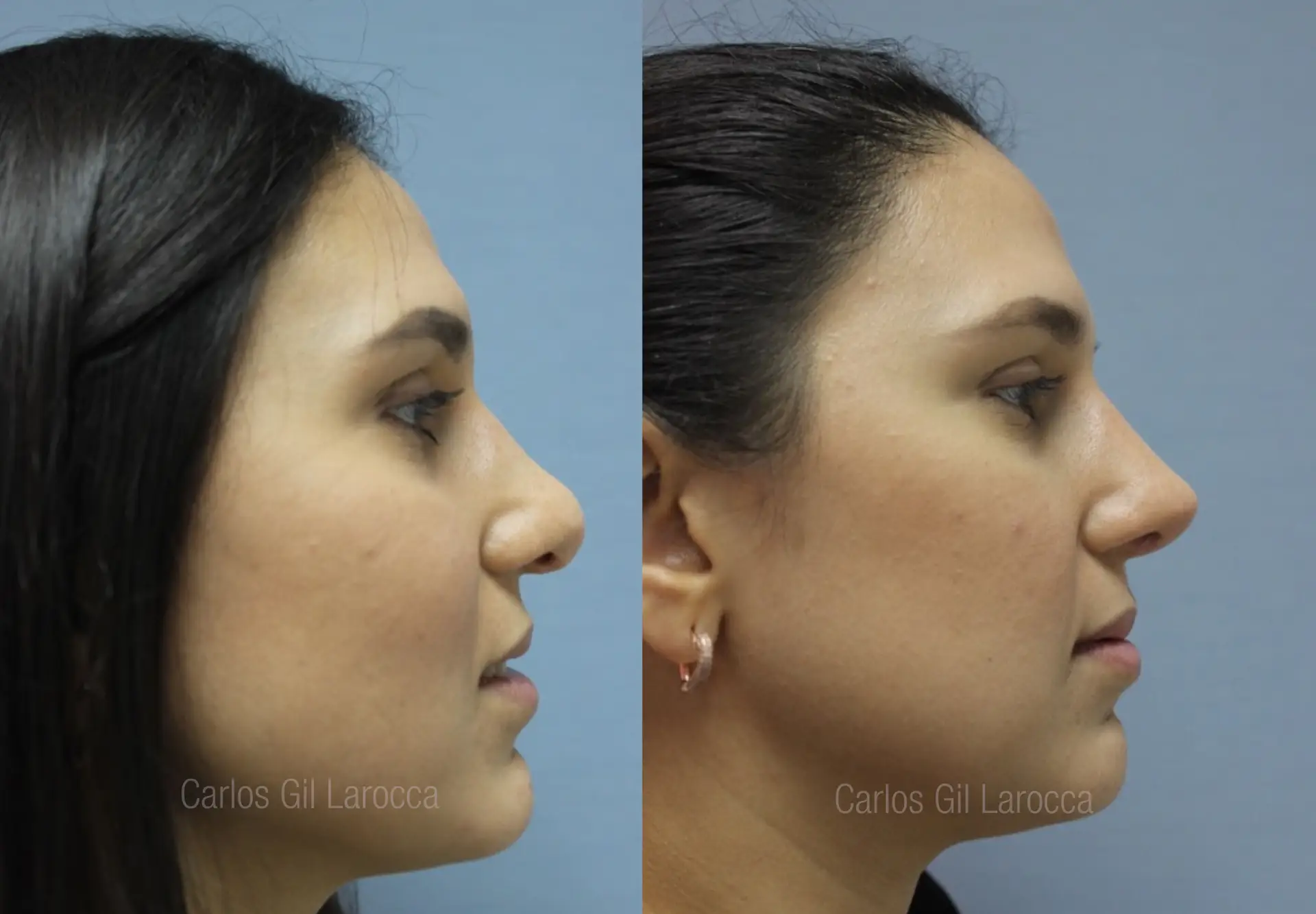 Resultado de rinoplastia, caso 2, vista 2
