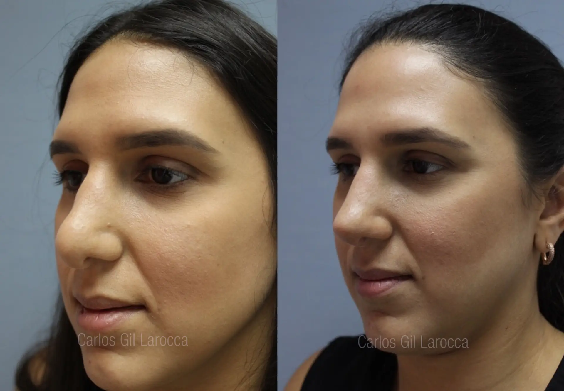Resultado de rinoplastia, caso 2, vista 3
