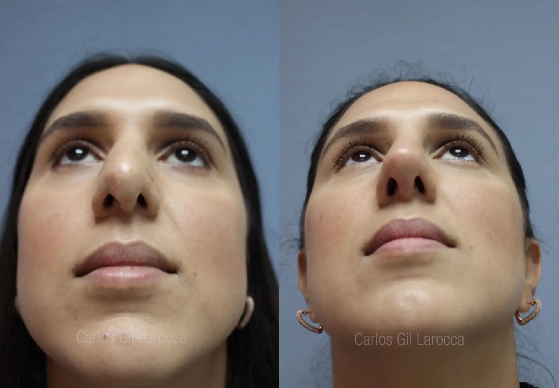 Resultado de rinoplastia, caso 2, vista 4