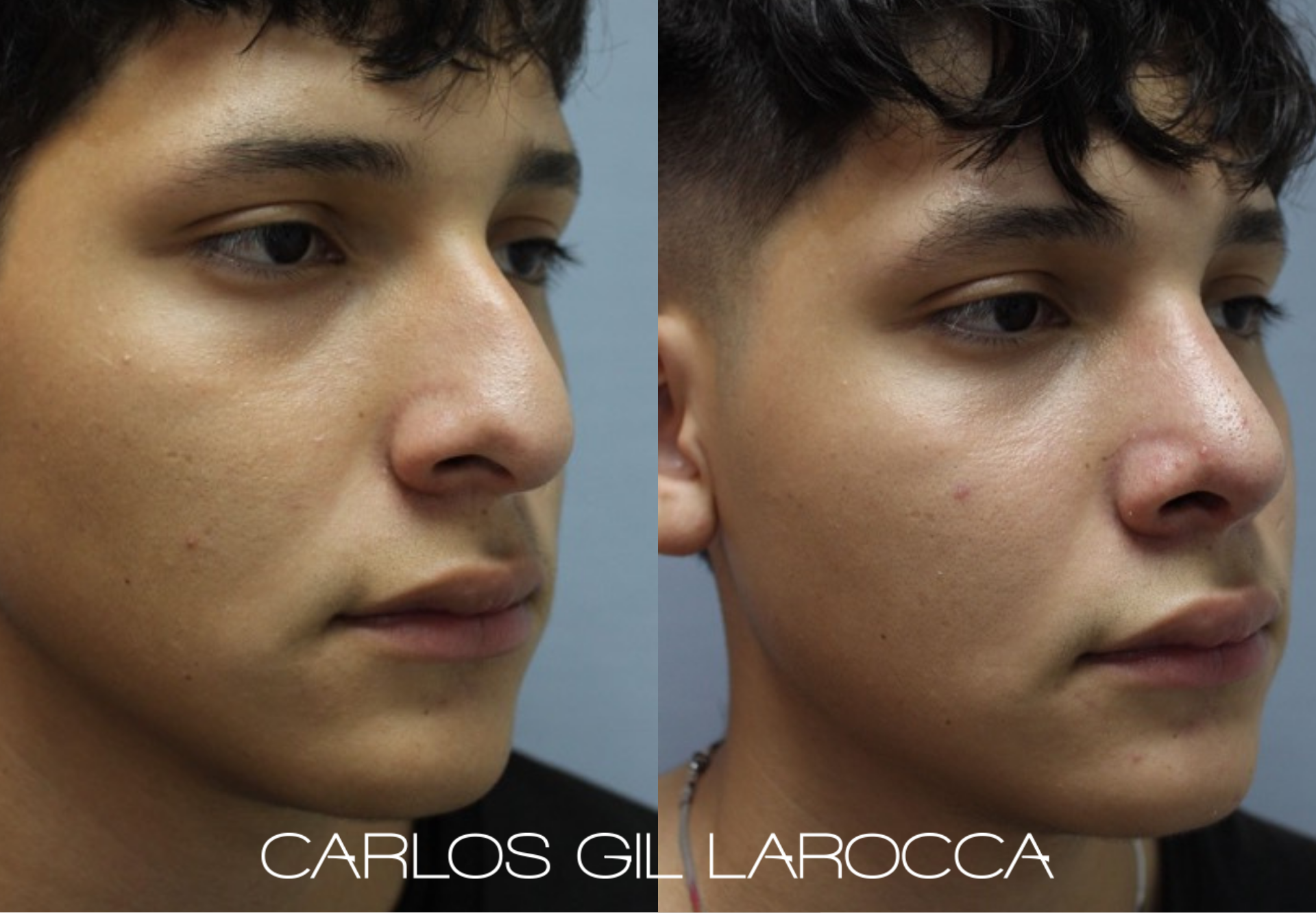 Resultado de rinoplastia, caso 9