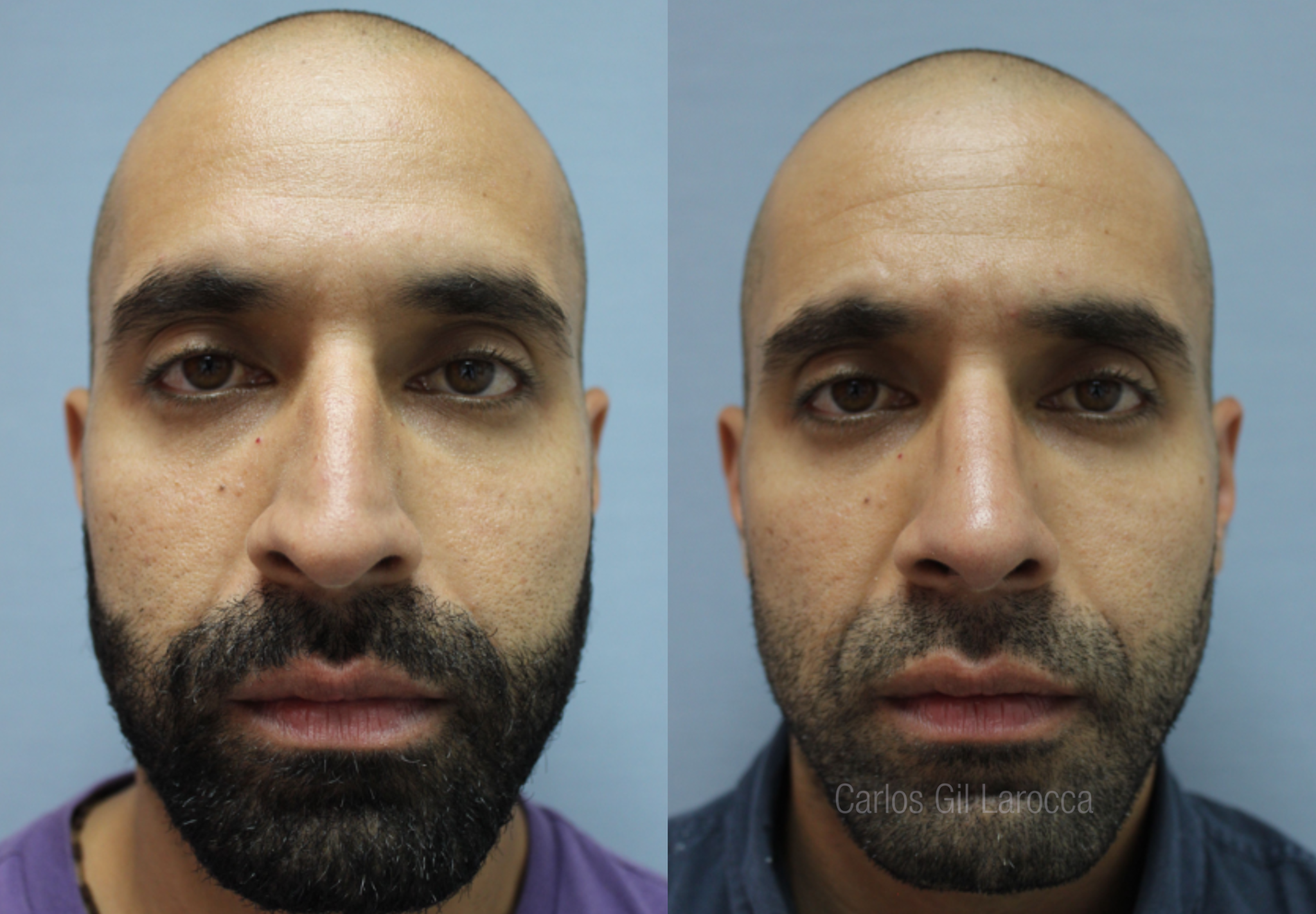 Resultado de rinoplastia, caso 5, vista 1