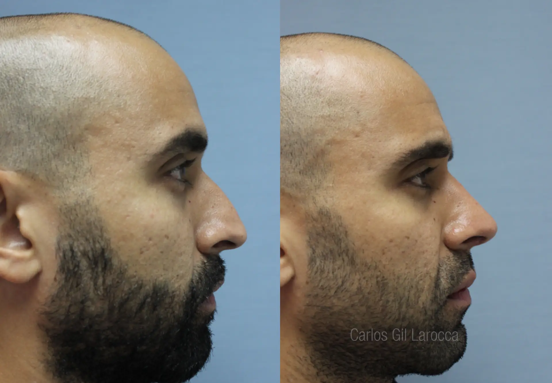 Resultado de rinoplastia, caso 5, vista 2