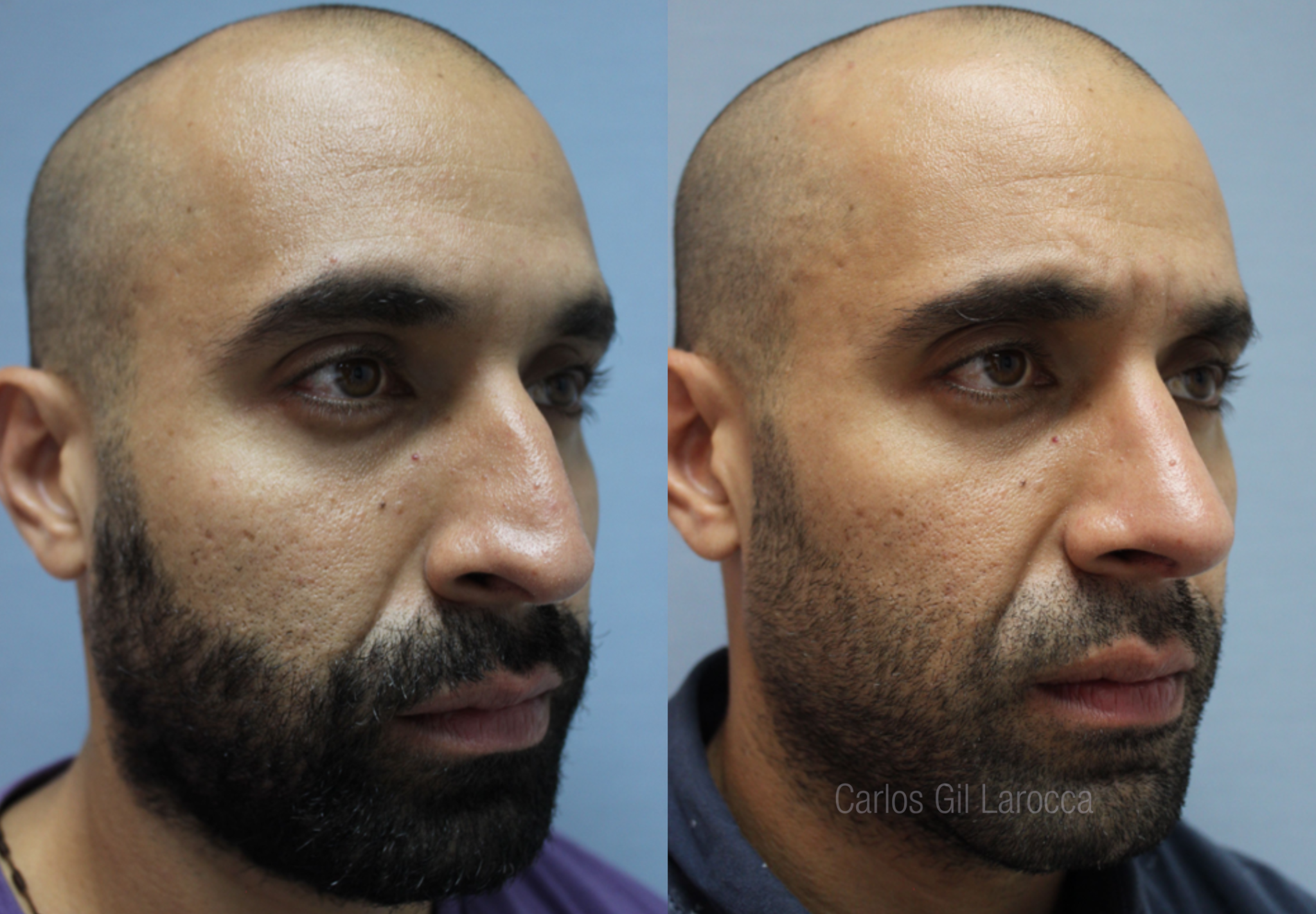 Resultado de rinoplastia, caso 5, vista 3