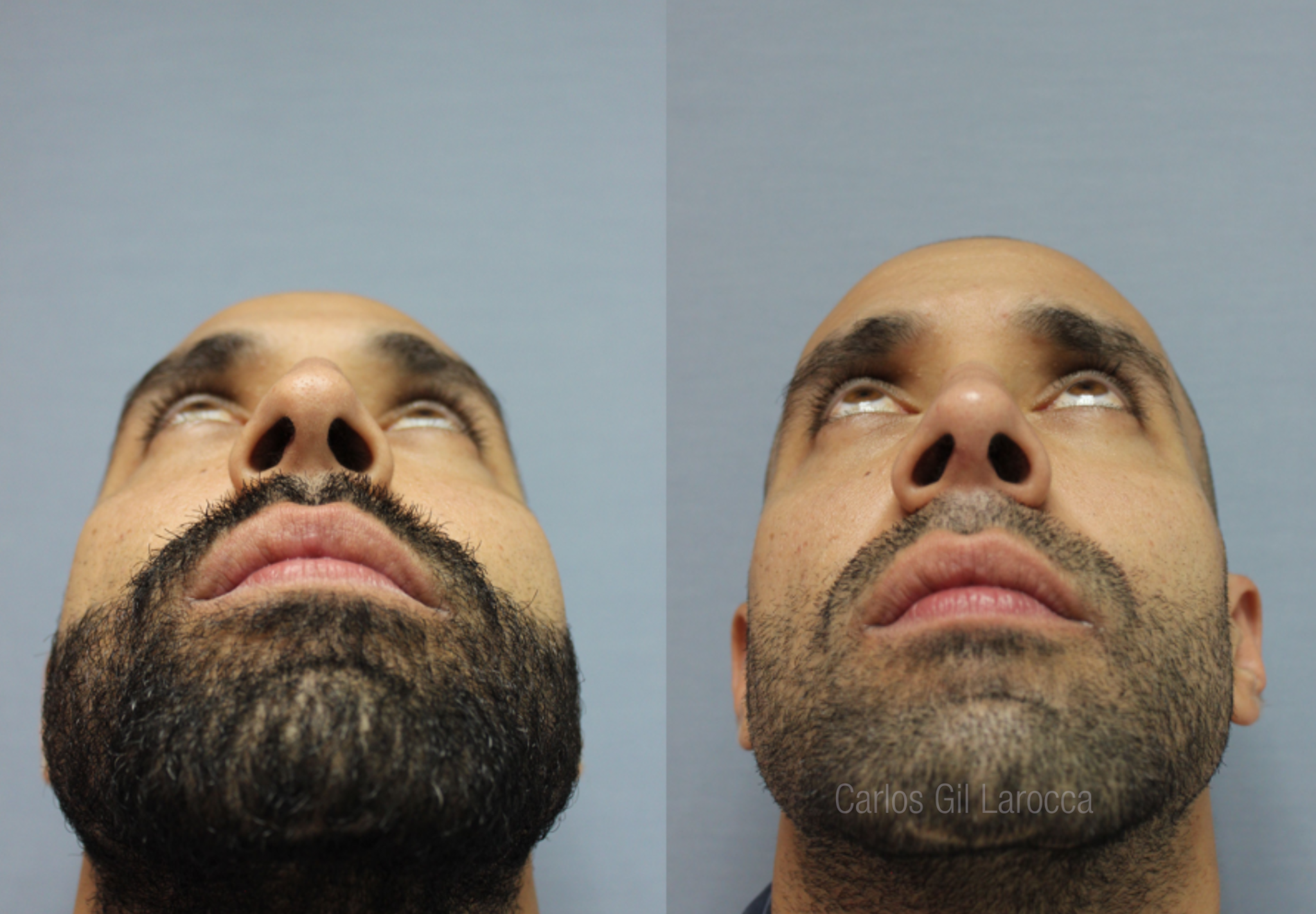 Resultado de rinoplastia, caso 5, vista 4