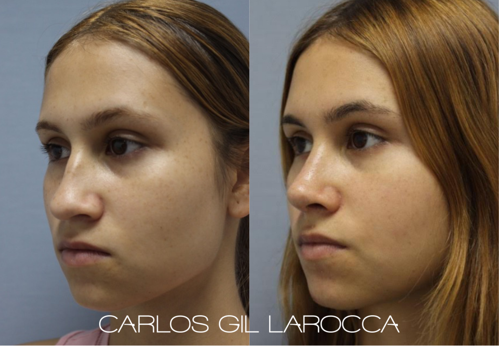 Resultado de rinoplastia, caso 16