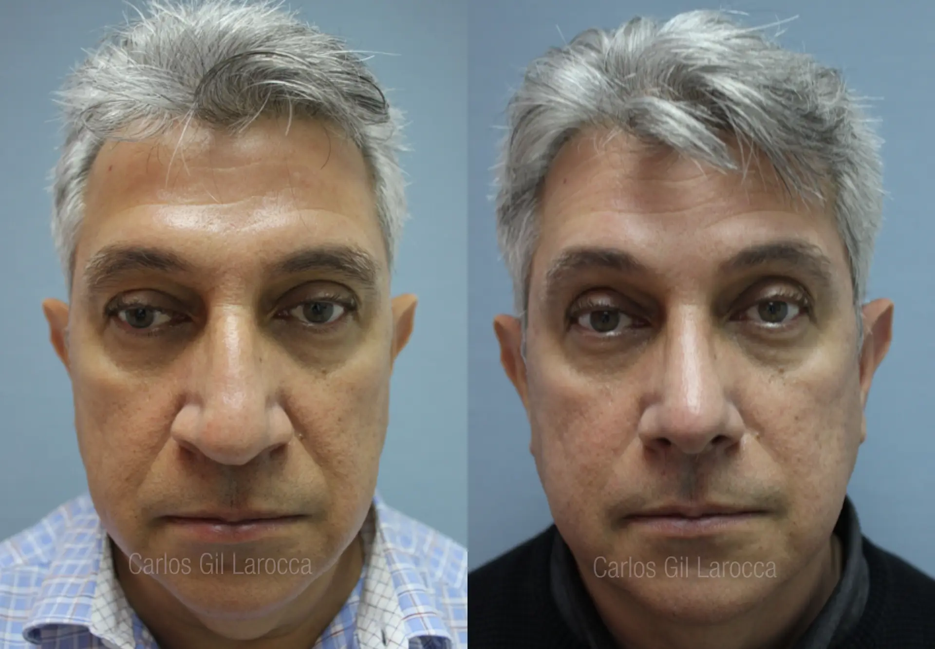 Resultado de rinoplastia, caso 4, vista 1