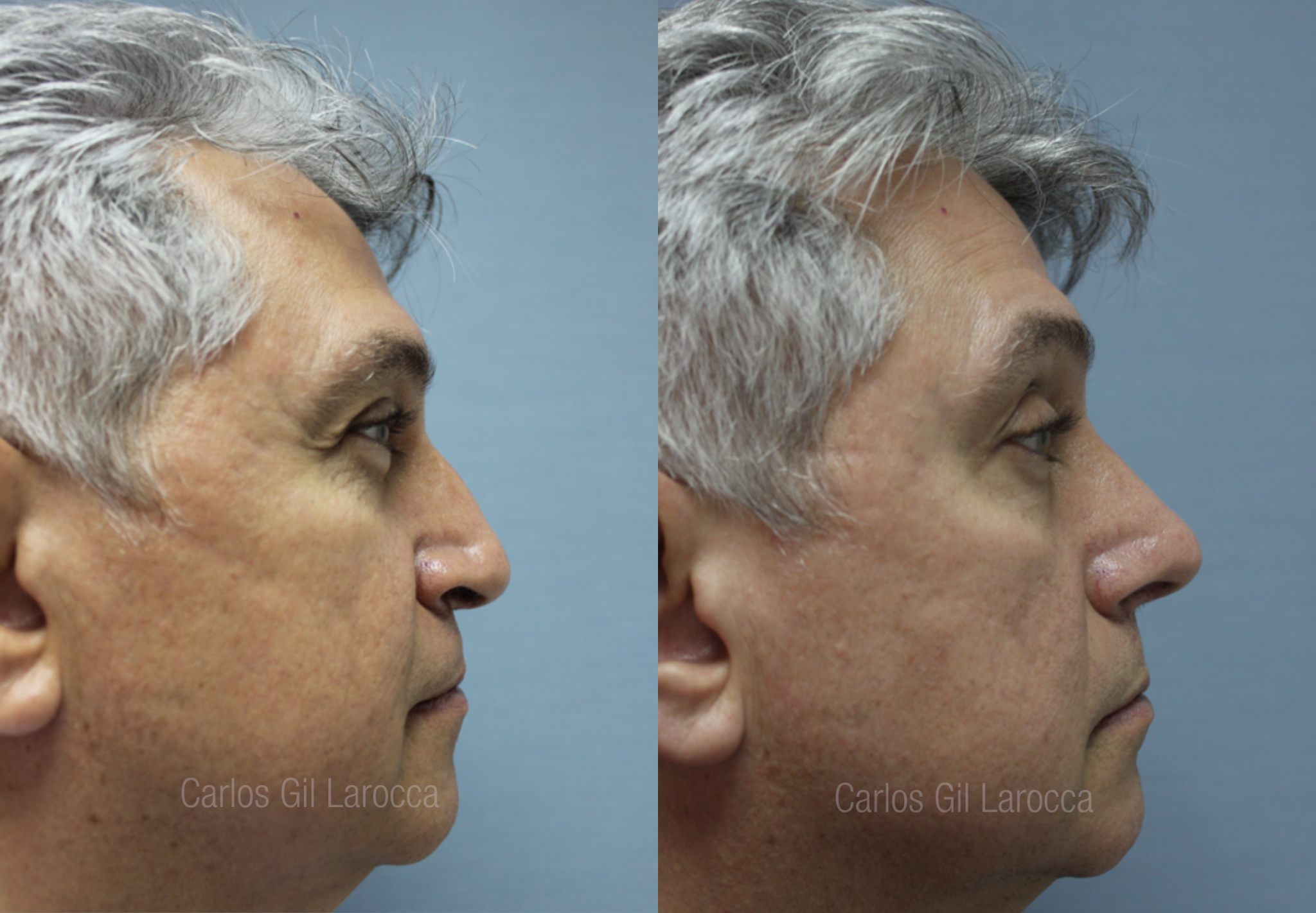 Resultado de rinoplastia, caso 4, vista 2