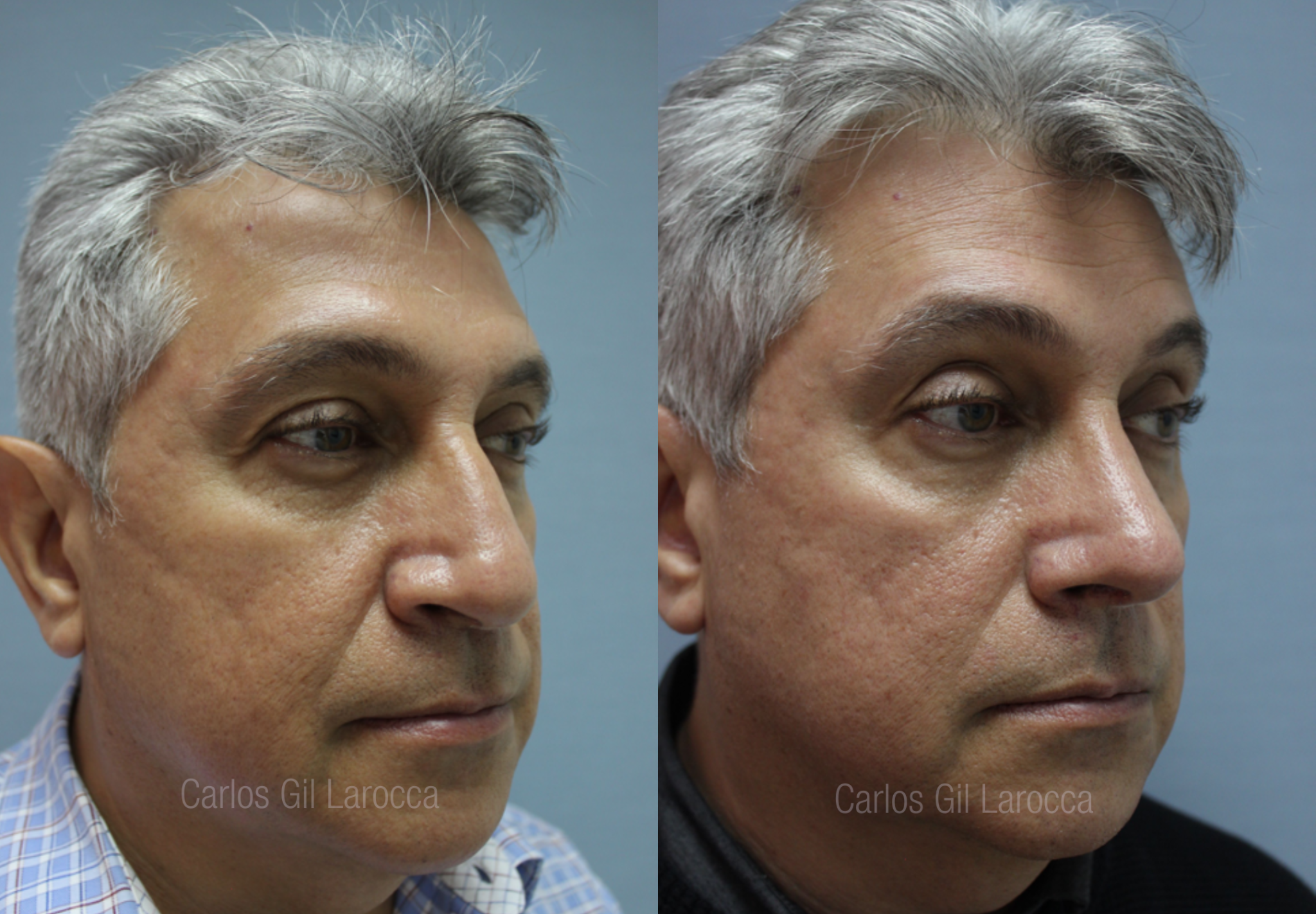 Resultado de rinoplastia, caso 4, vista 3