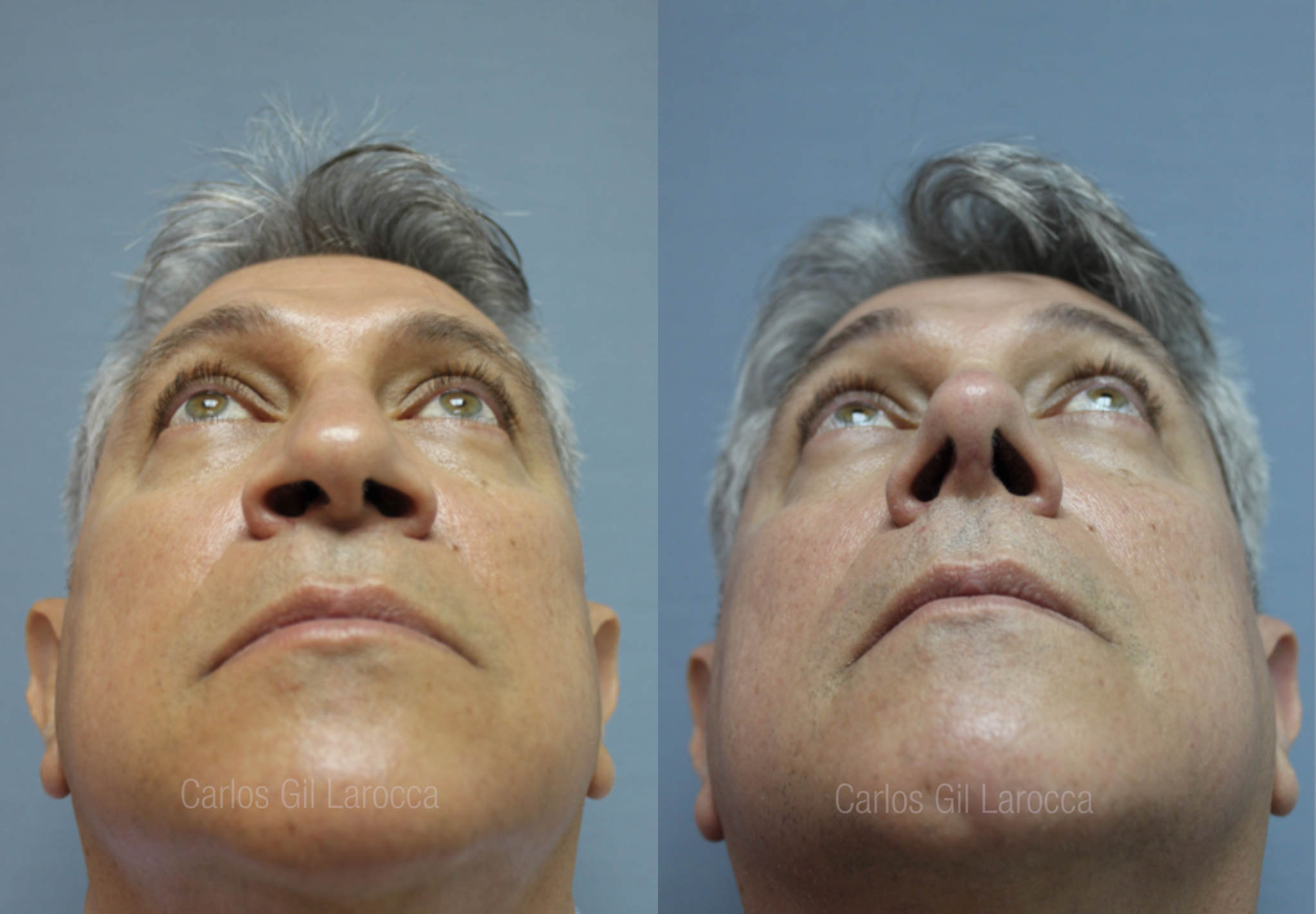 Resultado de rinoplastia, caso 4, vista 4