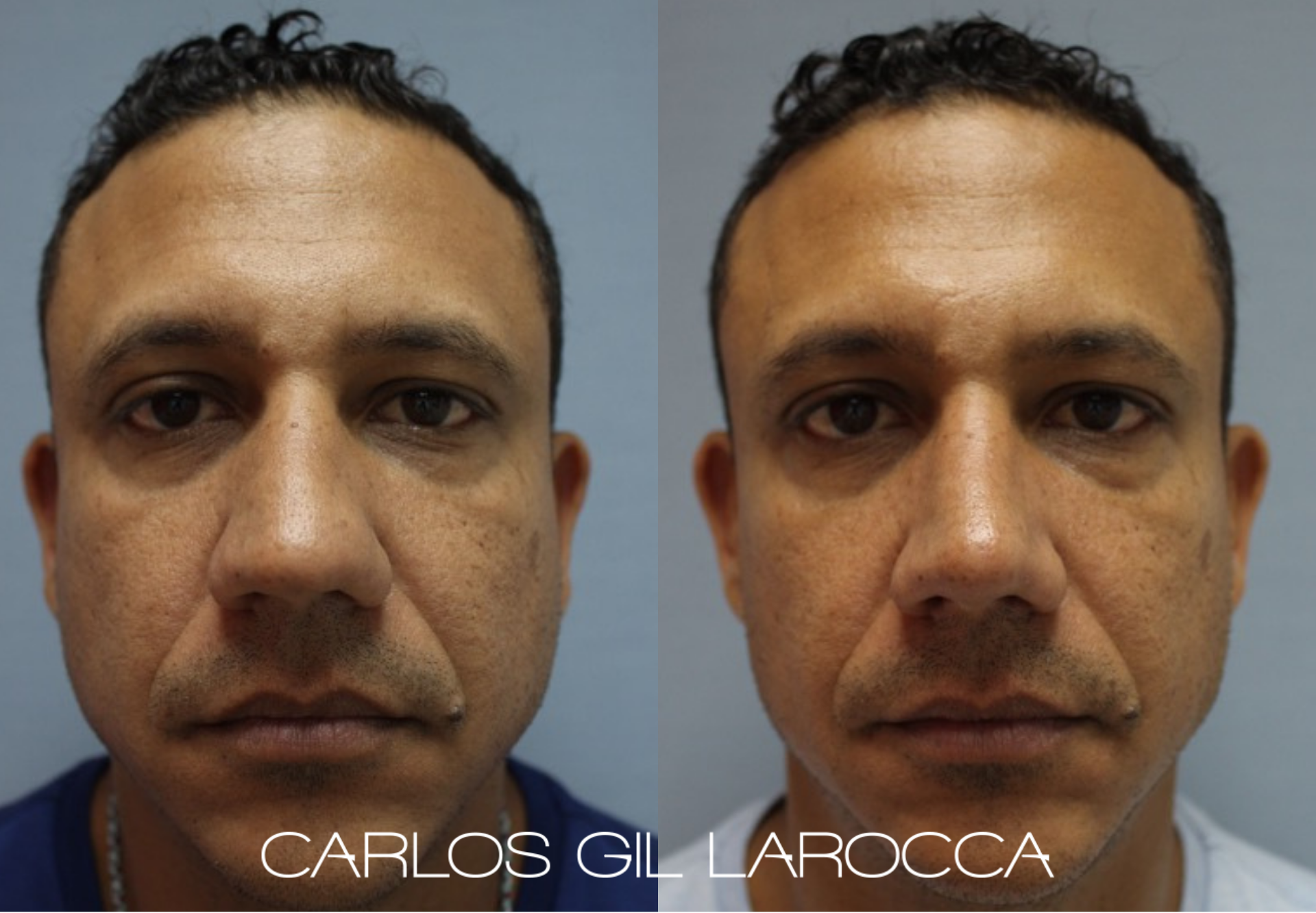 Resultado de rinoplastia, caso 6, vista 1