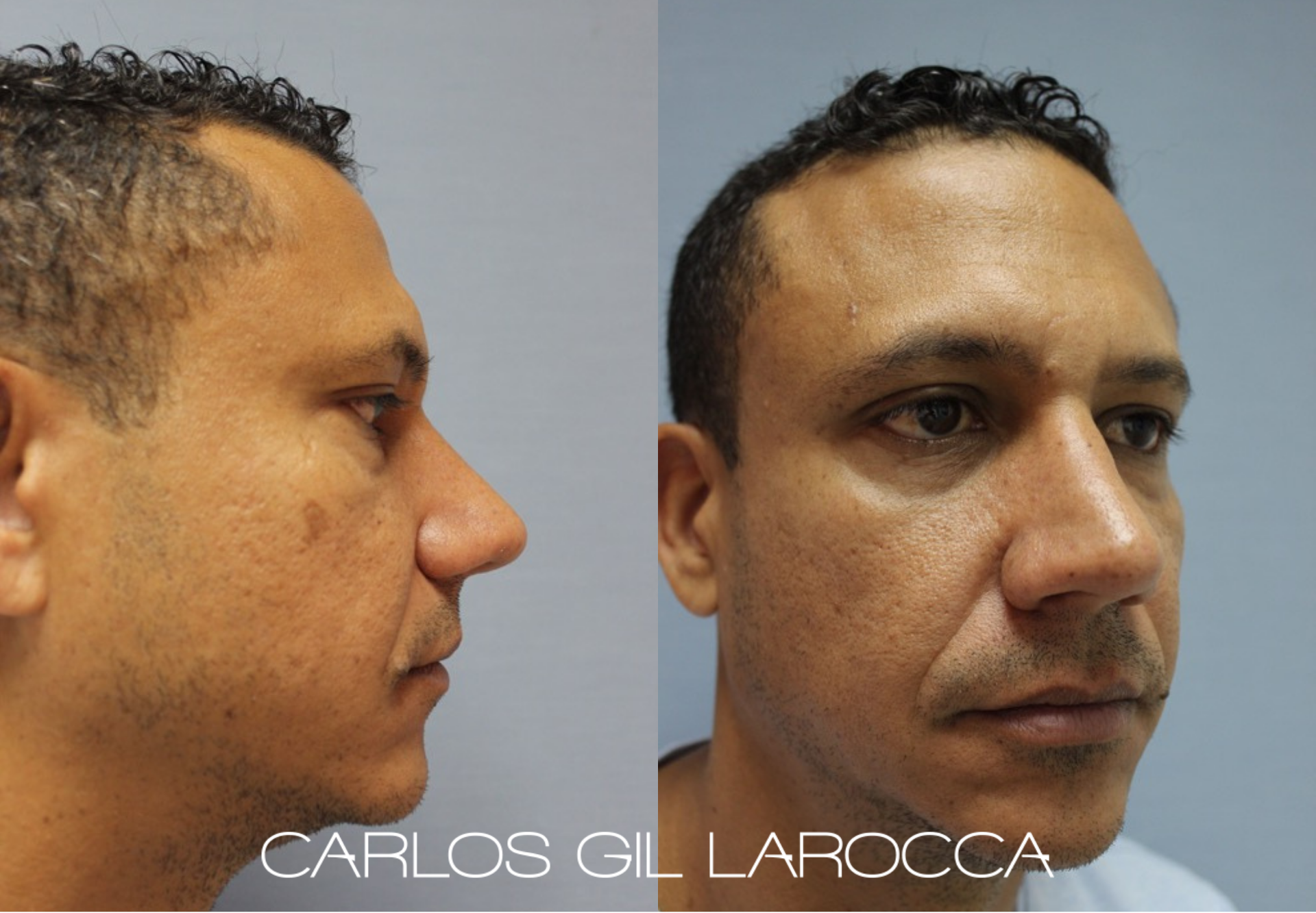 Resultado de rinoplastia, caso 6, vista 2