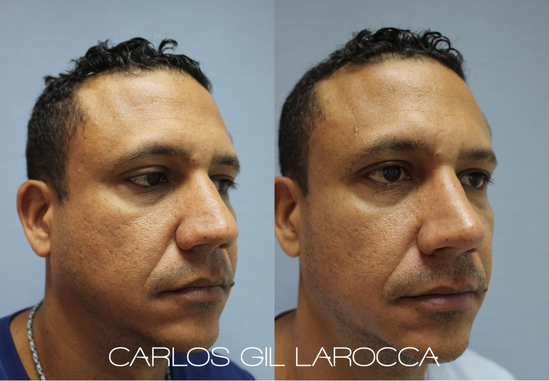 Resultado de rinoplastia, caso 6, vista 3