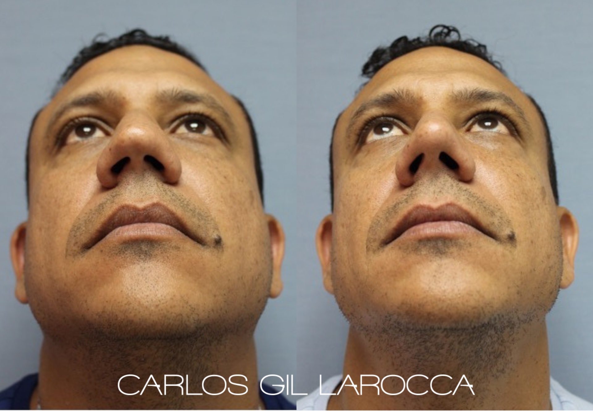 Resultado de rinoplastia, caso 6, vista 4