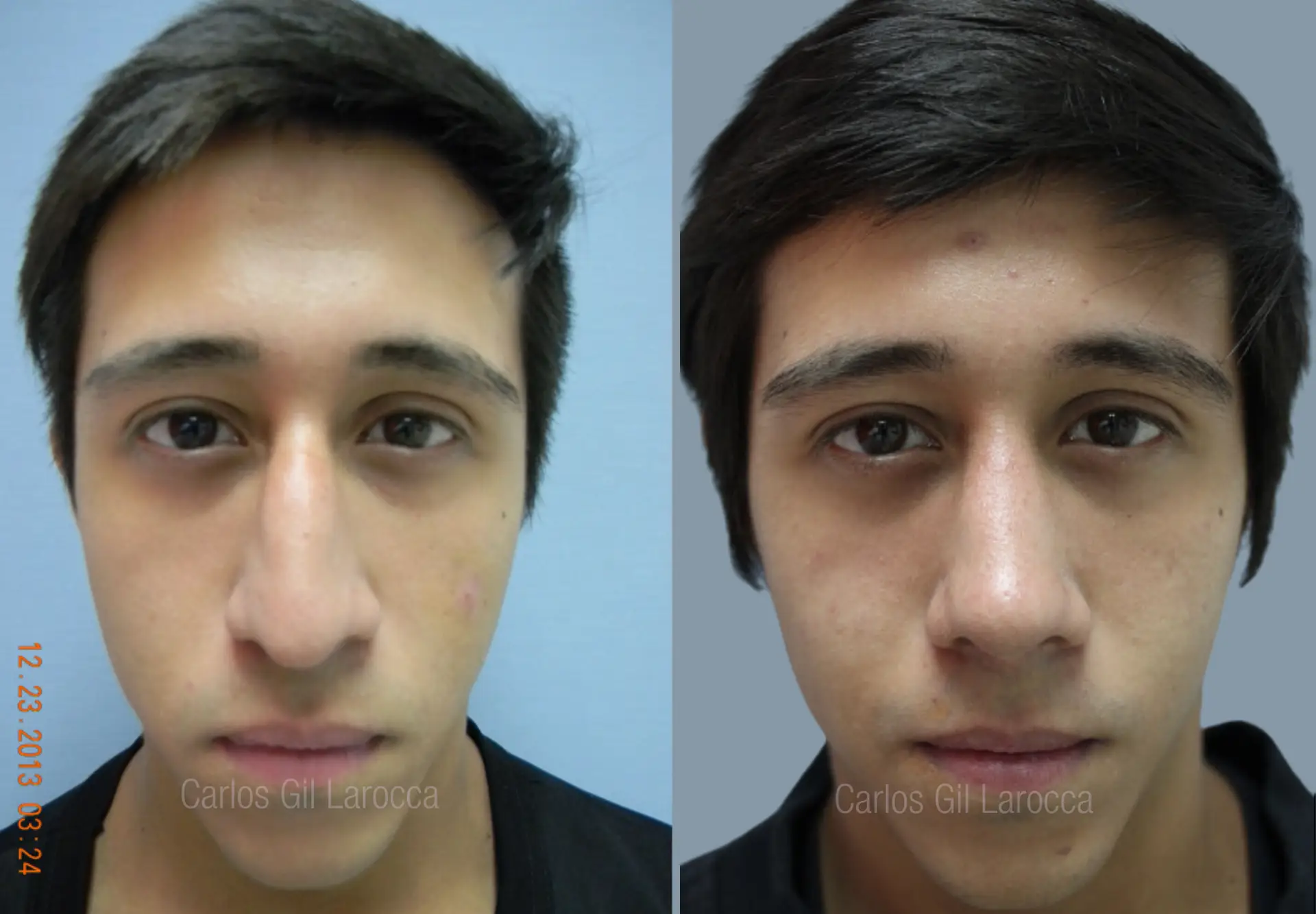 Resultado de rinoplastia, caso 3, vista 1