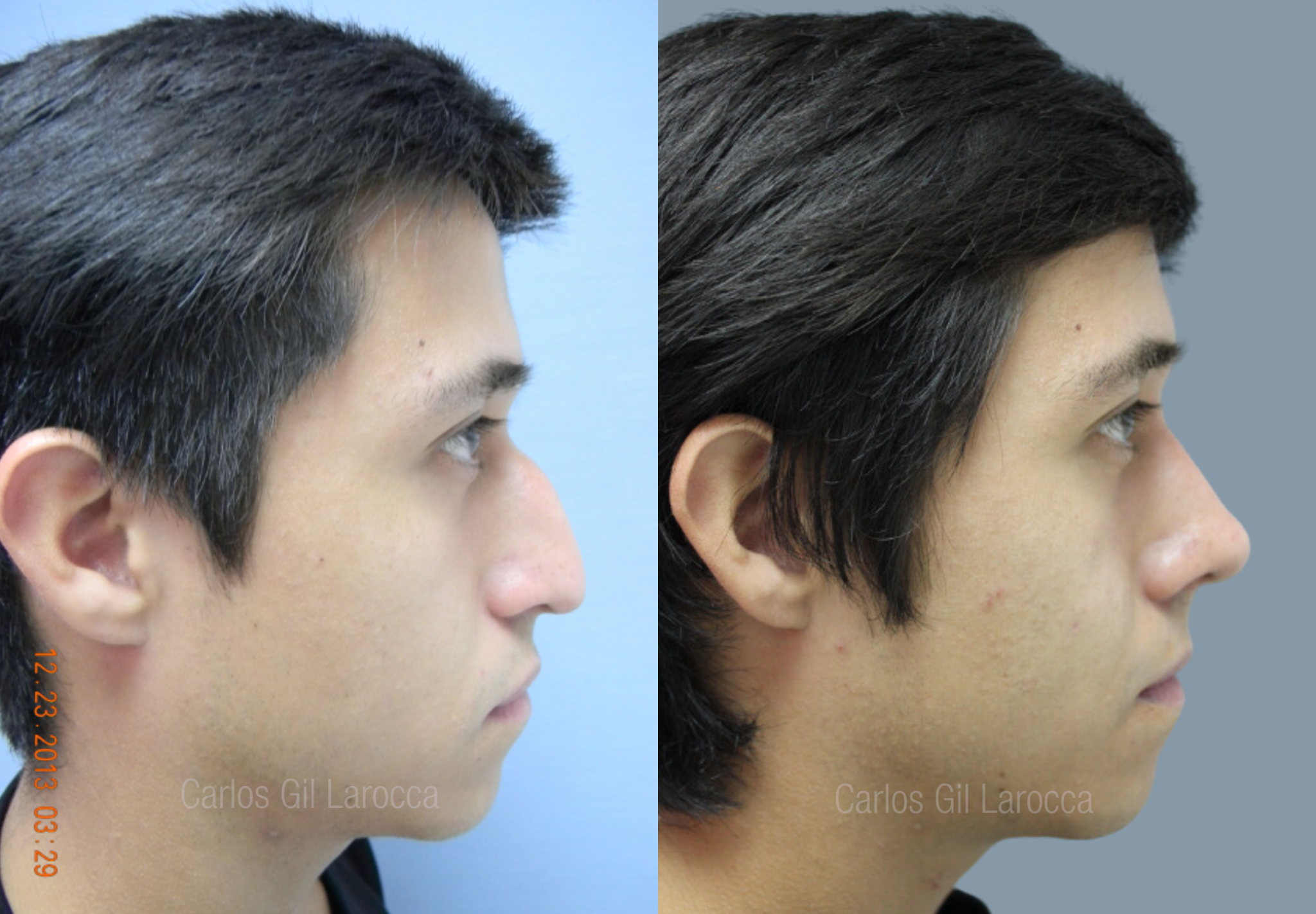 Resultado de rinoplastia, caso 3, vista 2