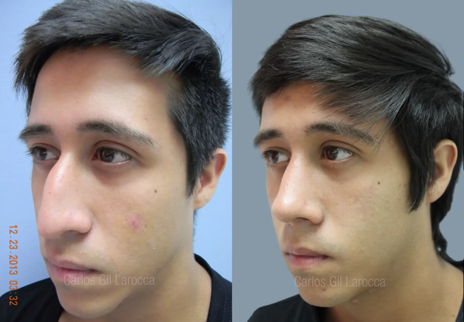 Resultado de rinoplastia, caso 3, vista 3
