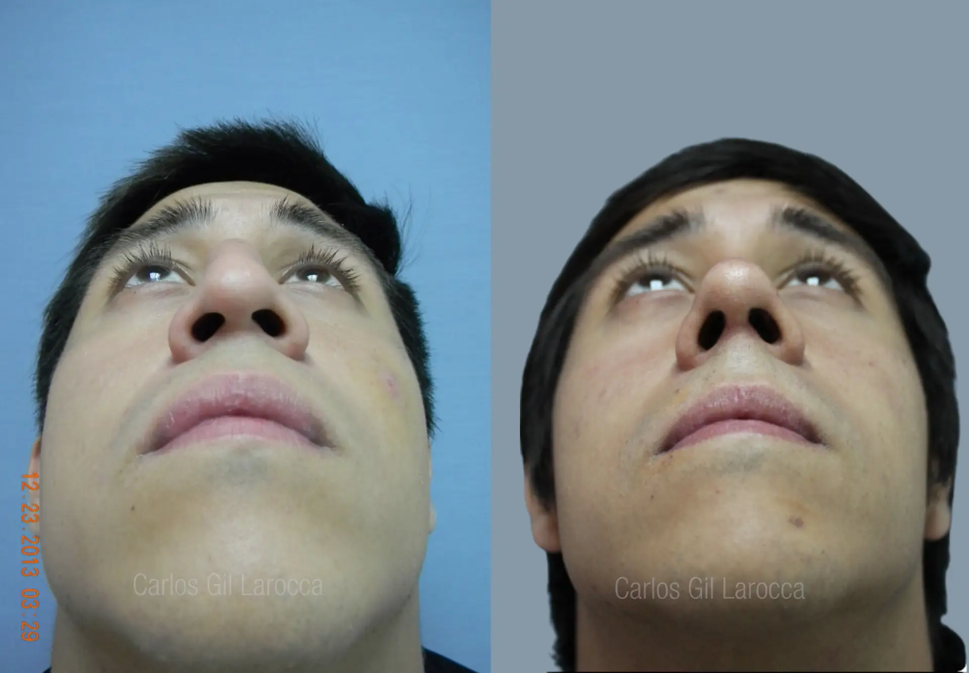 Resultado de rinoplastia, caso 3, vista 4
