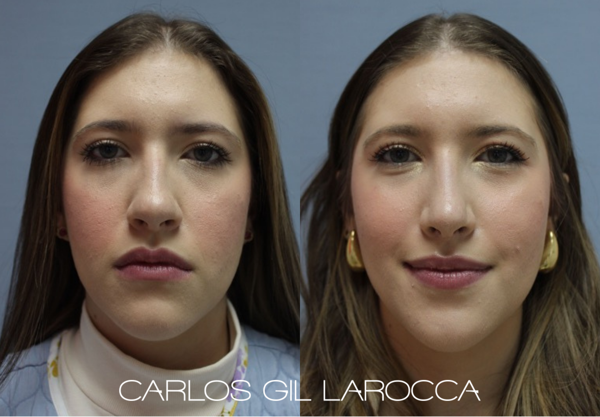Resultado de rinoplastia, caso 8