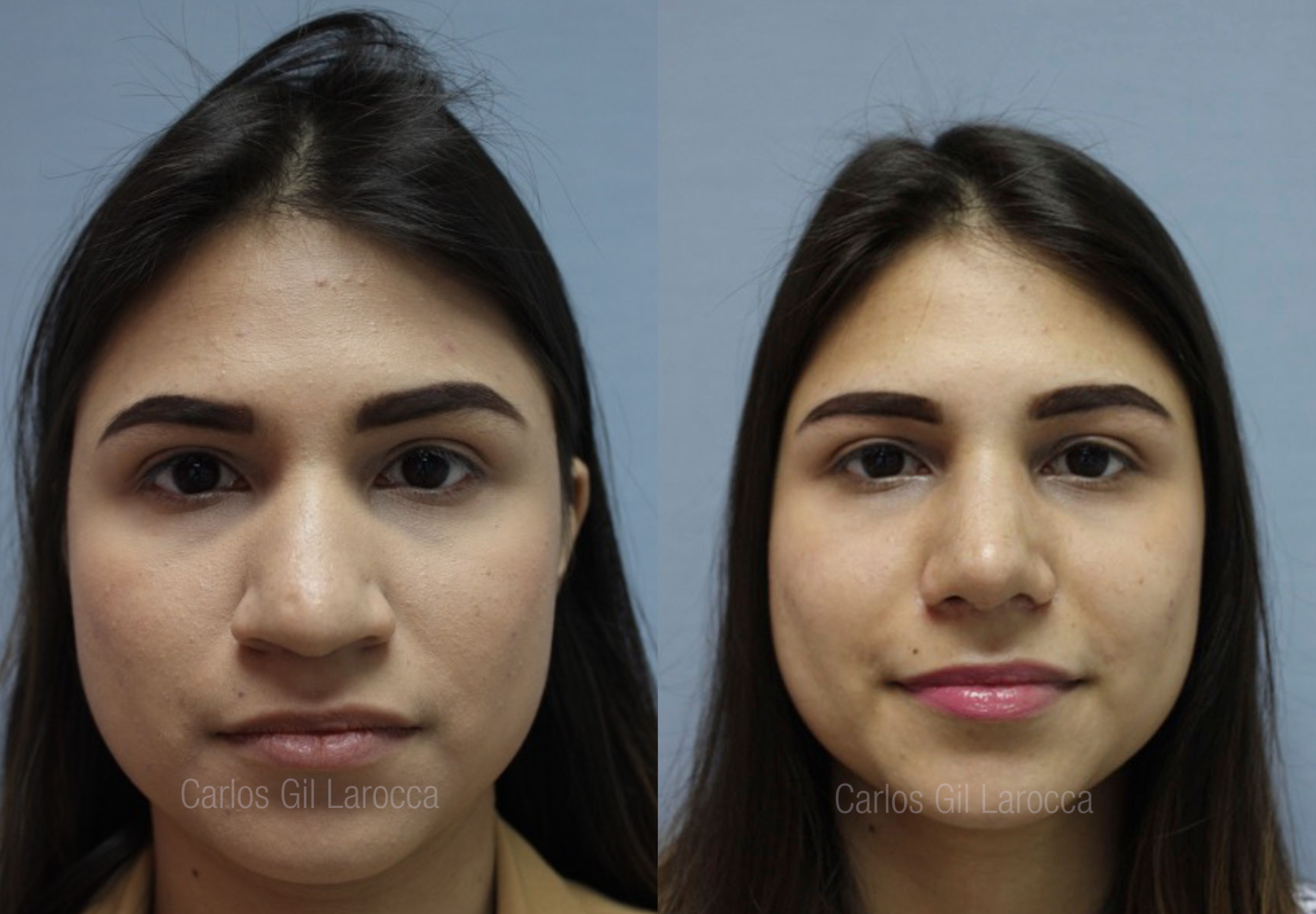 Resultado de rinoplastia, caso 1, vista 1