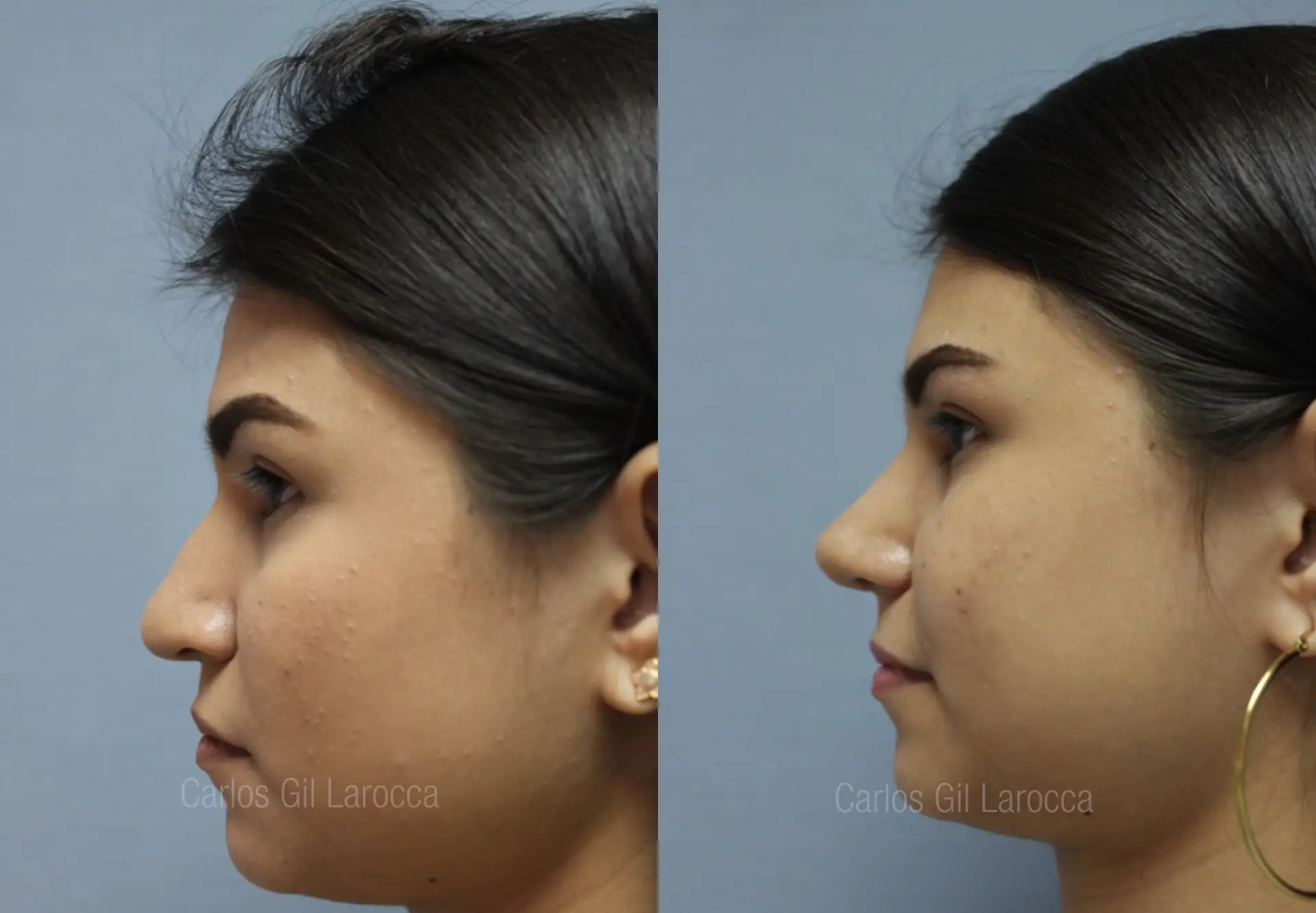 Resultado de rinoplastia, caso 1, vista 2