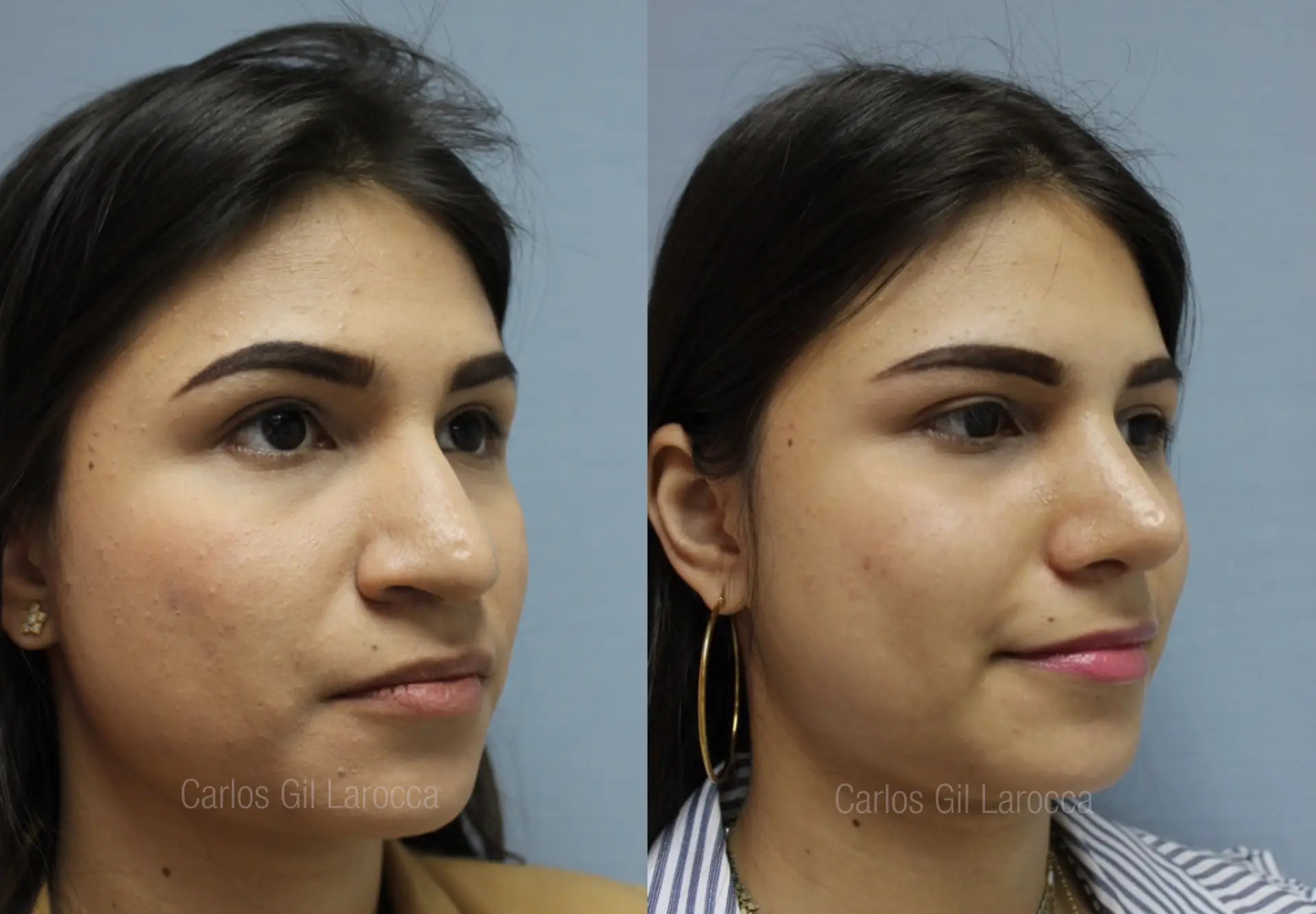 Resultado de rinoplastia, caso 1, vista 3