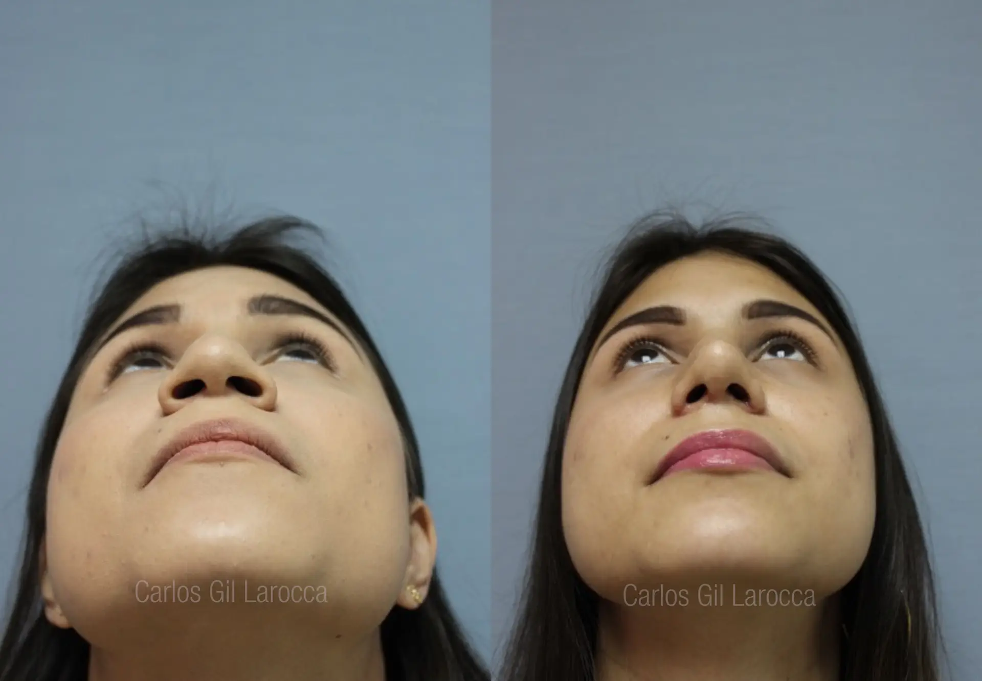 Resultado de rinoplastia, caso 1, vista 4