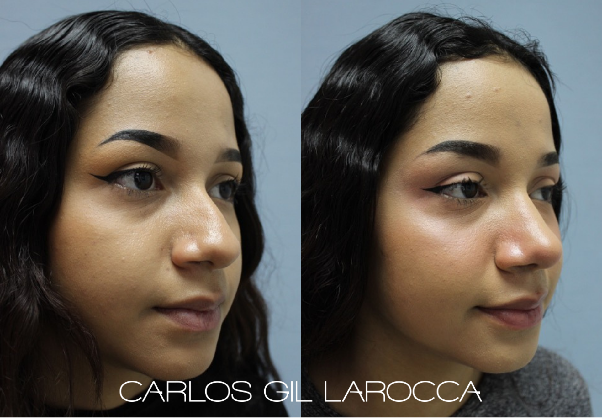 Resultado de rinoplastia, caso 10